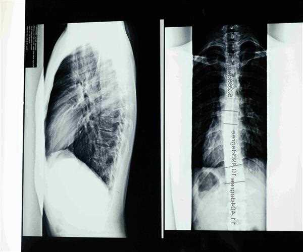 What is the main cause of Scoliosis?