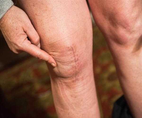 What are the signs of knee arthritis?