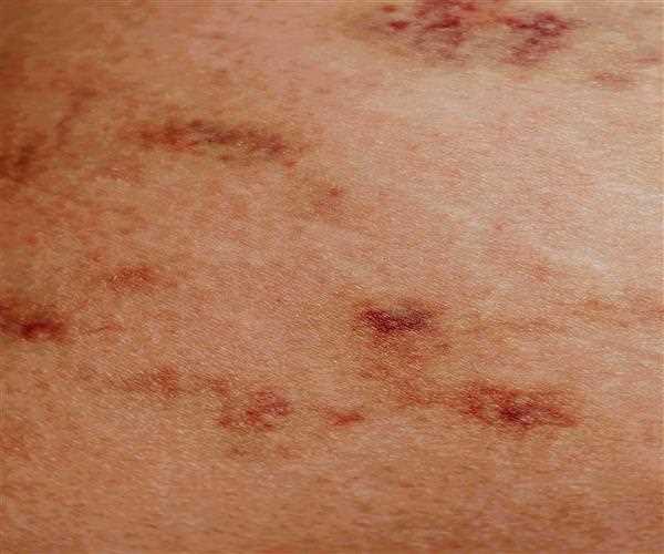 What is Chicken Pox? Symptoms and Causes