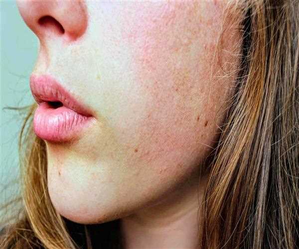 Winter Dry Skin: Causes, Treatments and more