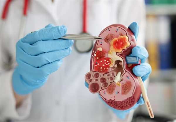 Kidney Transplant Surgery in India for International Patients