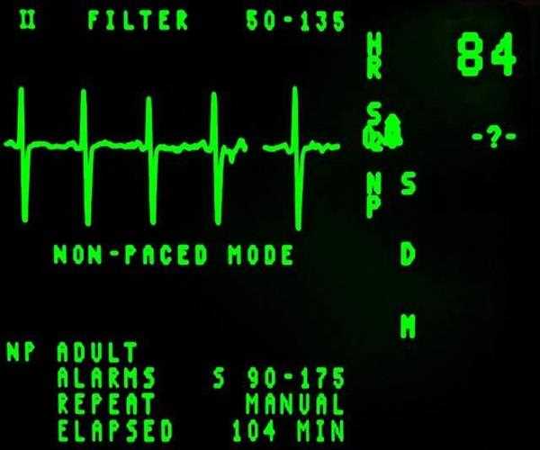 Heart Disease and Electrocardiogram