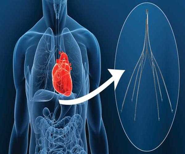 Three Primary Signs of Defective IVC Filter